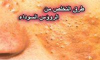 الرؤوس السوداء في الوجه والانف